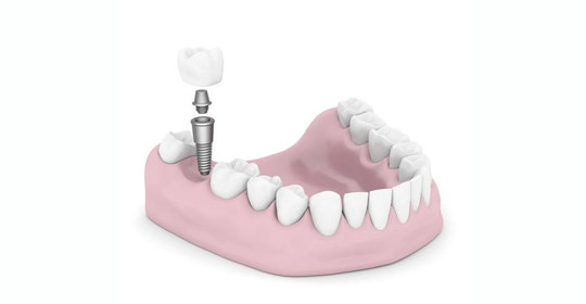 Die vielen Vorteile der Zahnimplantate